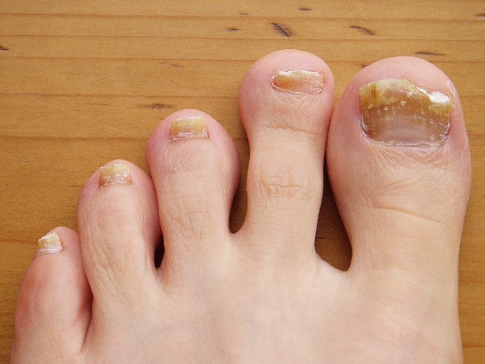 nail fungus