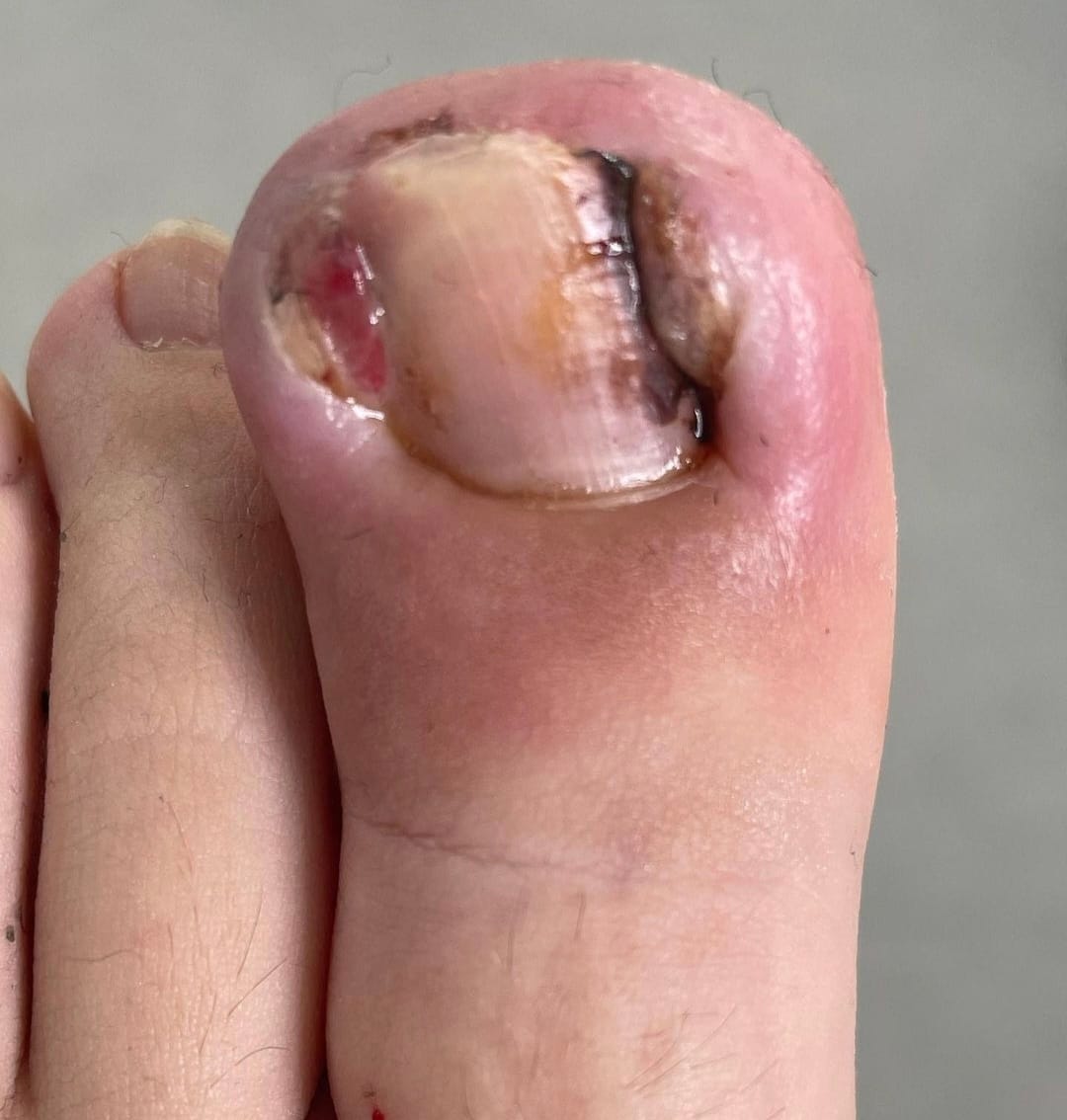 When should I see a podiatrist about my ingrown toenail? - Active Care  Podiatry