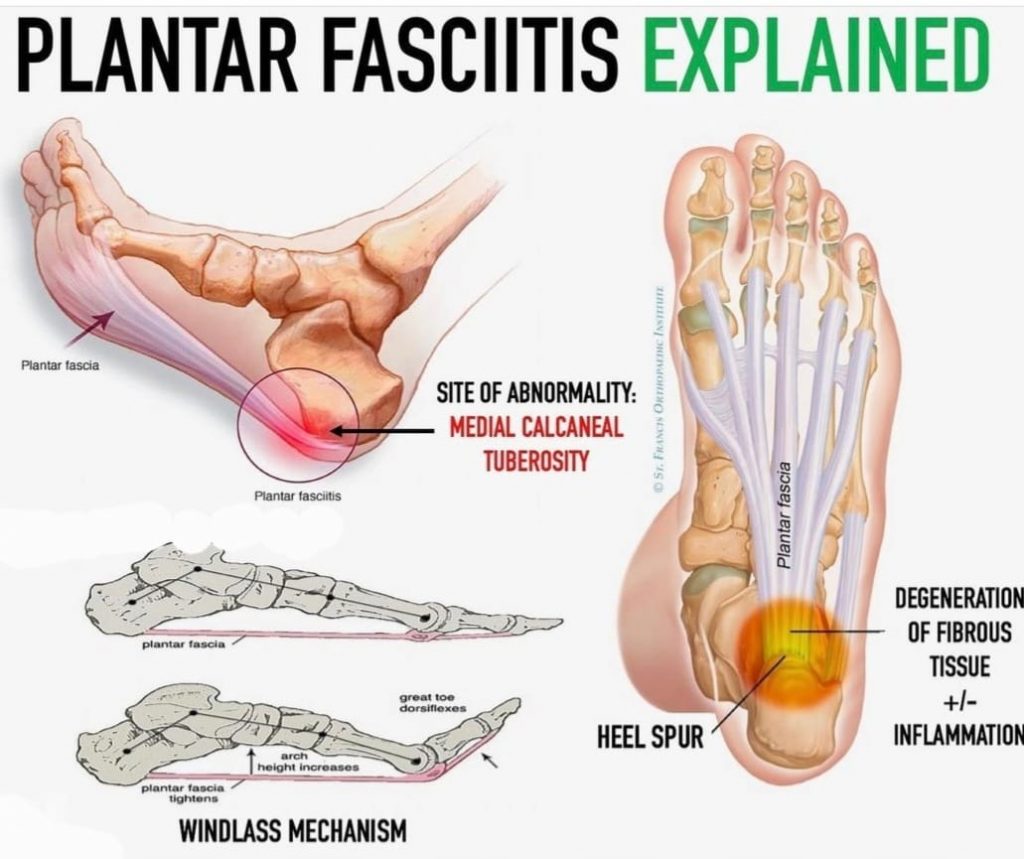 Plantar Fasciitis treatment at My Foot Doctor (Chiropodist & Podiatrist) in  Motherwell offers a wide variety of treatment for plantar fasciitis,  insoles, orthotics, low level laser therapy,
